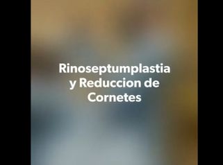 Rinoplastia - Fasent. Dr Rolando de la Garza Giacomán
