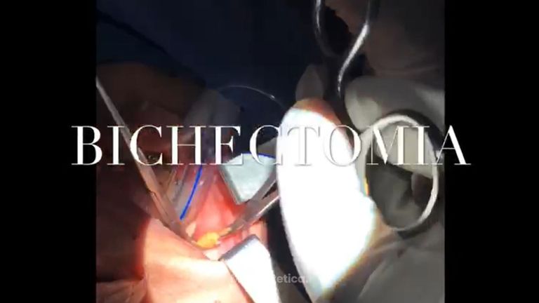 Bichectomía