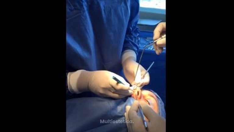 Rinoplastia