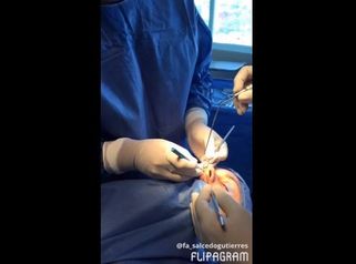 Rinoplastia