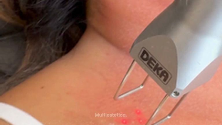 COOL PEEL + MORPHEUS 8 - Dr. Irvin J Cervantes