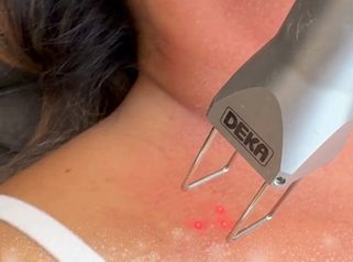 COOL PEEL + MORPHEUS 8 - Dr. Irvin J Cervantes