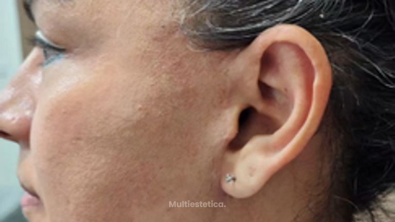 Lifting cicatriz 3 meses - Dr. Alejandro Cruz Segura