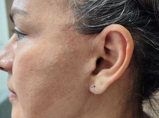 Lifting cicatriz 3 meses - Dr. Alejandro Cruz Segura