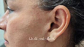 Lifting cicatriz 3 meses - Dr. Alejandro Cruz Segura