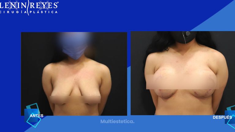 Mastopexia - Dr. Lenin Alfonso Reyes Ibarra