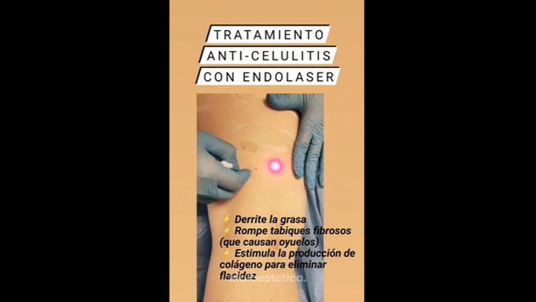 Celulitis - Clínica Heal Aesthetics