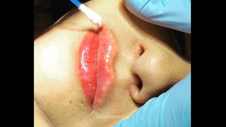 Aumento de labios