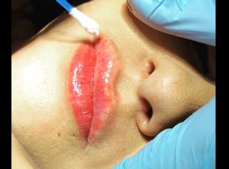 Aumento de labios