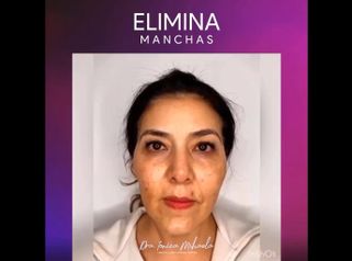 Eliminacion Manchas - Dra. Ionica Mihaela Dogaru