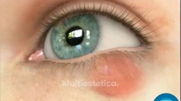 Chalazion