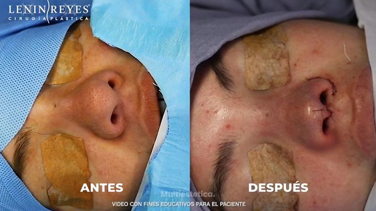 Rinoplastia - Dr. Lenin Alfonso Reyes Ibarra