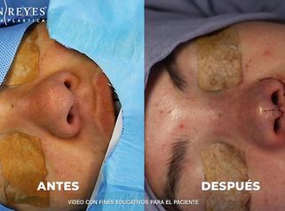 Rinoplastia - Dr. Lenin Alfonso Reyes Ibarra