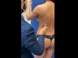 Liposucción - Dr. Carlos González Alvarado
