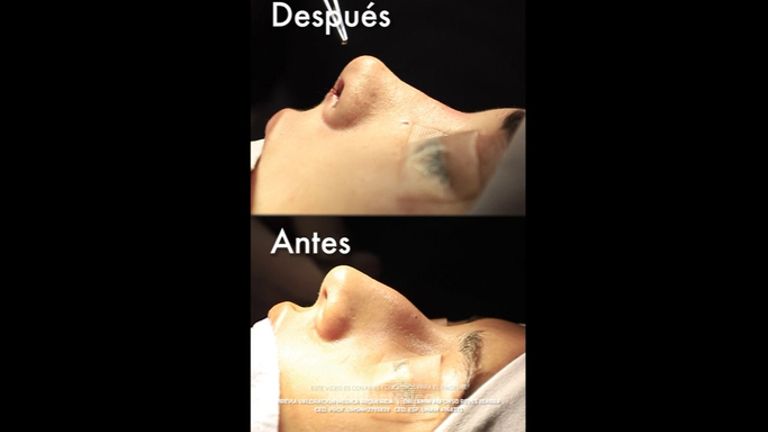 Rinoplastia - Dr. Lenin Alfonso Reyes Ibarra