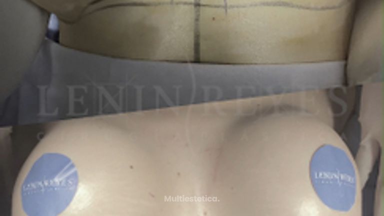Mastopexia - Dr. Lenin Alfonso Reyes Ibarra