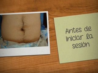 Lipoescultura - Dr. Daniel Jacintos García 