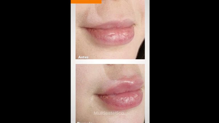 Aumento de labios - Dr. Fernando Cherizola Morales