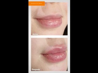 Aumento de labios - Dr. Fernando Cherizola Morales
