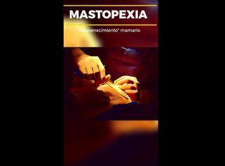 Mastopexia - Dr. Gerardo Muñoz Jiménez
