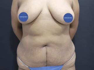 Liposucción - Dr. Lenin Alfonso Reyes Ibarra