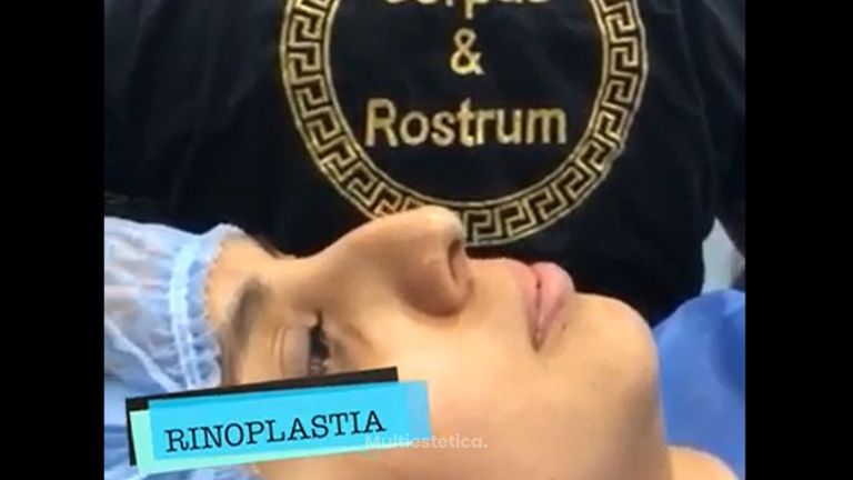 Rinoplastia
