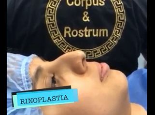 Rinoplastia