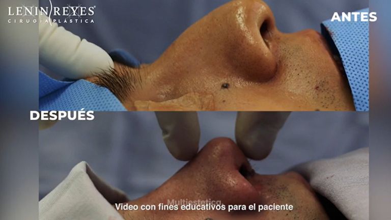 Rinoplastia