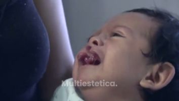 Cirugía para labio hendido