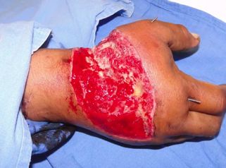 Así es la cirugía reconstructiva tras la amputación de una mano