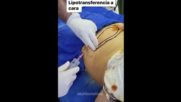 Liposucción - Dr. Jesús Omar Carreón Terrones